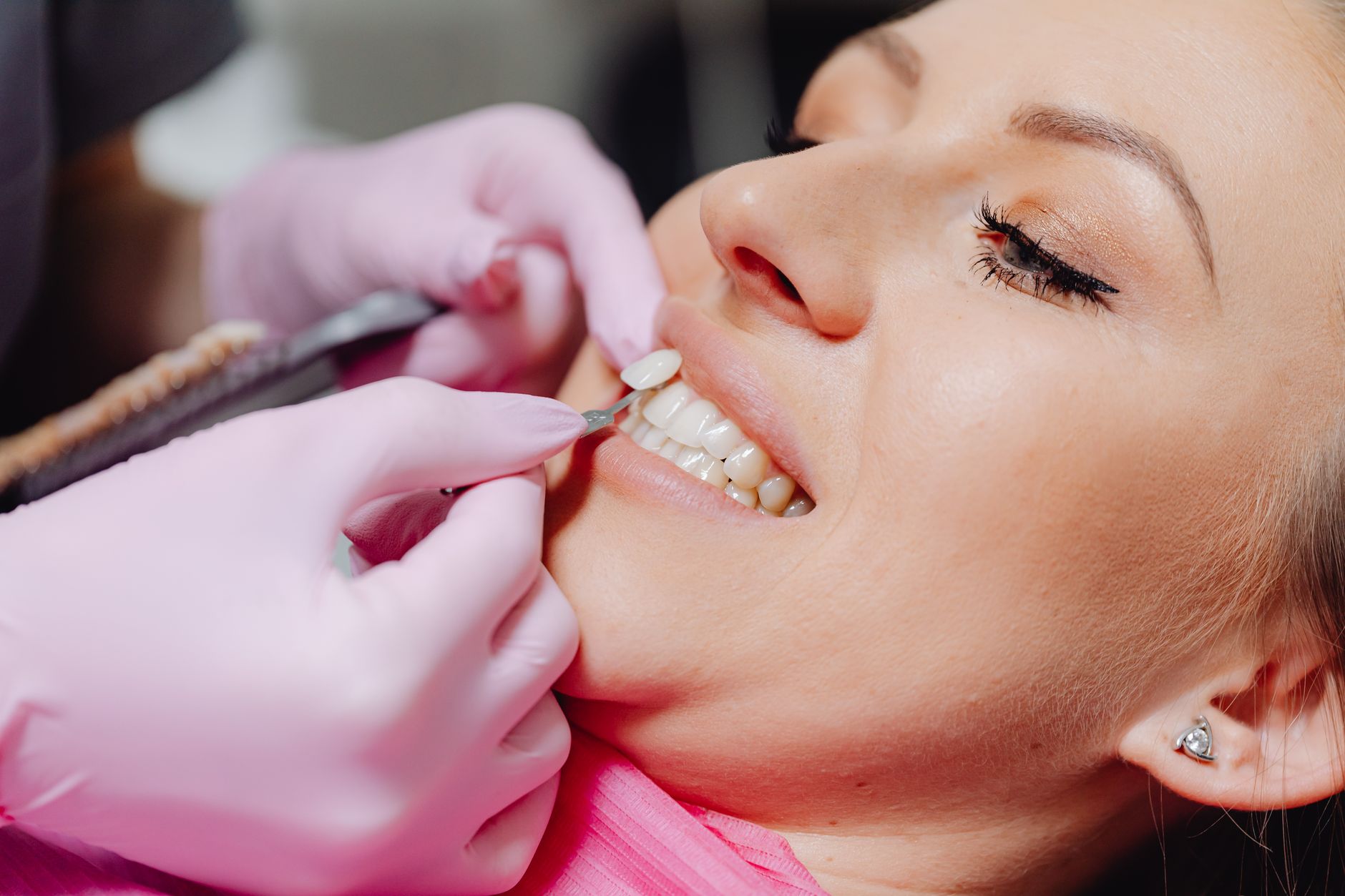 Close-up of dental crowns and veneers displayed on tooth models showing cosmetic dental restoration options