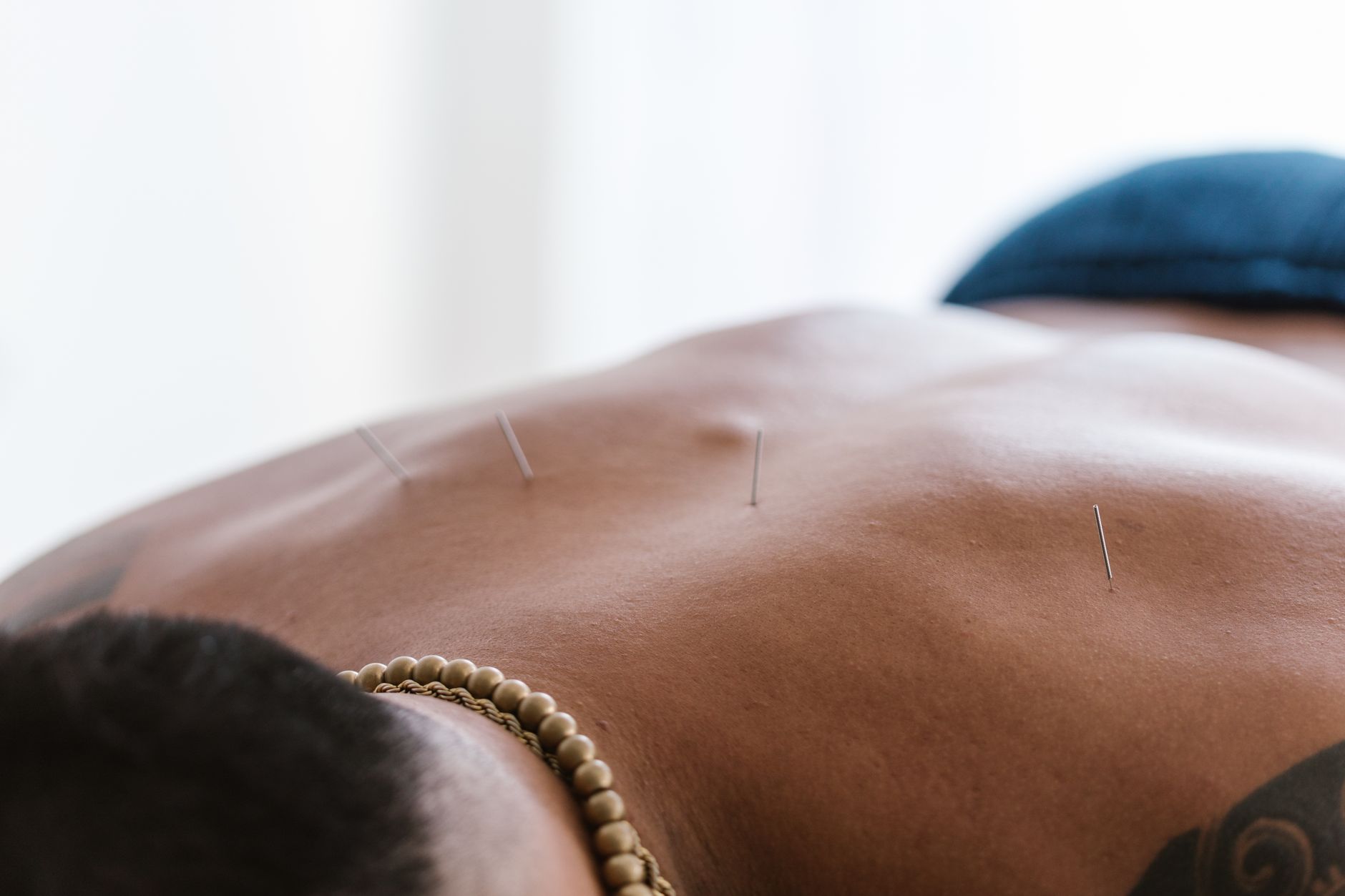 Patient receiving acupuncture treatment for chronic back pain management and relief